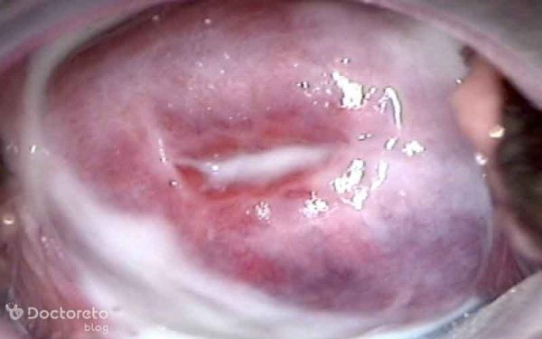  عکس واژن سالم بدون عفونت