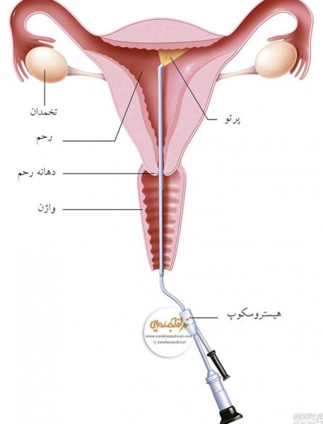  عکس رحم واقعی دختر