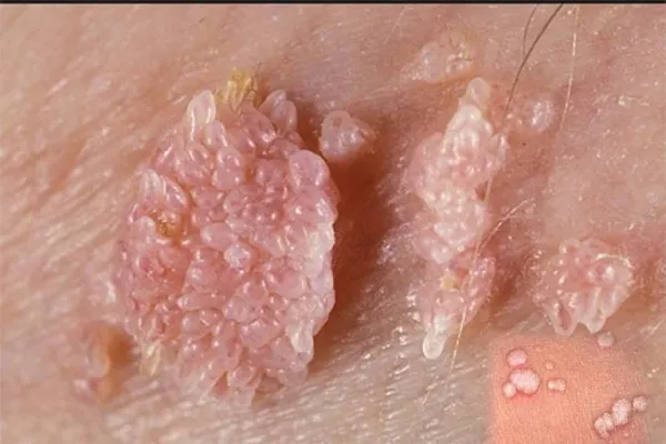 زگیل داخل واژن را چگونه از بین ببریم؟