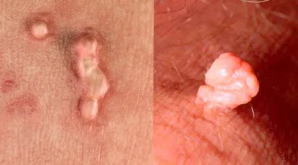  زگیل داخل واژن را چگونه از بین ببریم؟