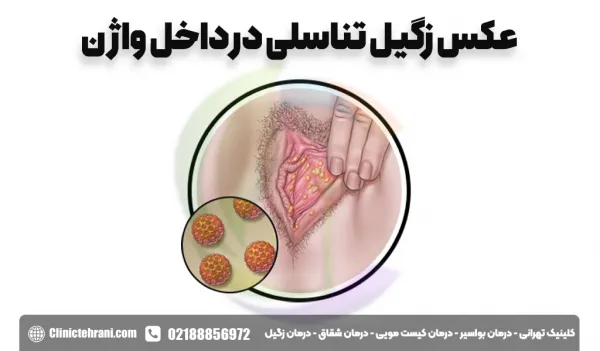 عکس واقعی واضح زگیل تناسلی در داخل واژن