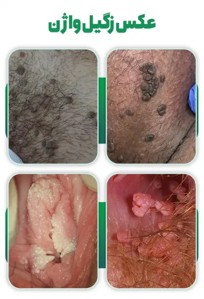  عکس واقعی واضح زگیل تناسلی در داخل واژن