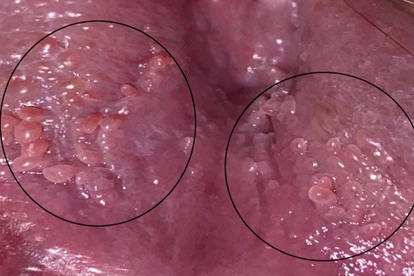  عکس واقعی واضح زگیل تناسلی در داخل واژن