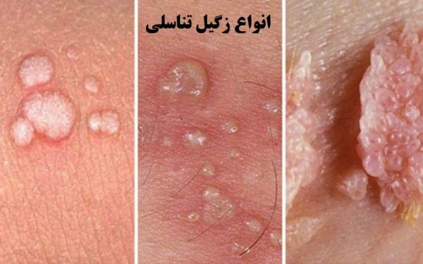  عکس واقعی واضح زگیل تناسلی در داخل واژن