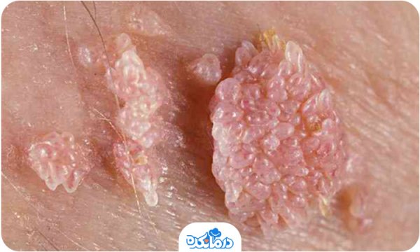 آیا زگیل تناسلی باعث بوی بد واژن می شود؟