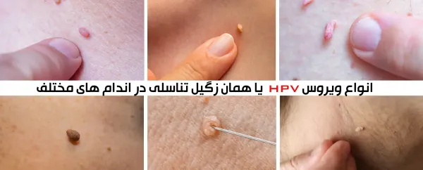  آیا زگیل تناسلی باعث بوی بد واژن می شود؟