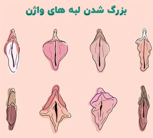 علت بزرگ شدن دستگاه تناسلی زنان