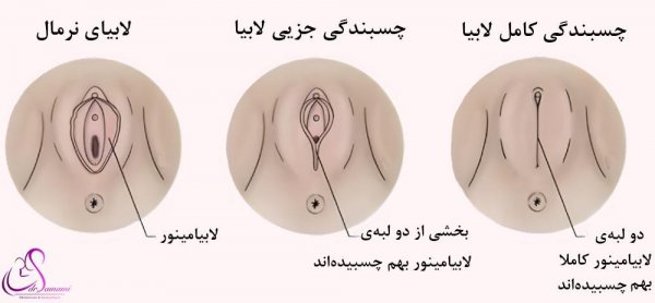  علت بزرگ شدن دستگاه تناسلی زنان