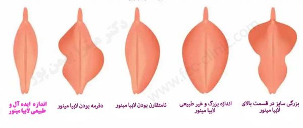  چگونه لابیا را صورتی کنیم؟
