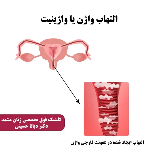  چگونه لبه های داخلی واژن را کوچک کنیم + درمان خانگی