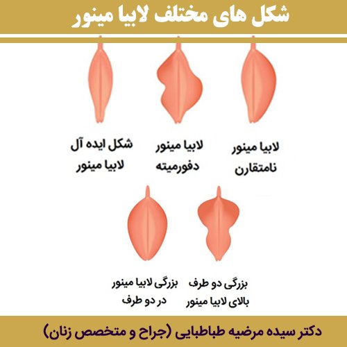  چگونه لبه های داخلی واژن را کوچک کنیم + درمان خانگی