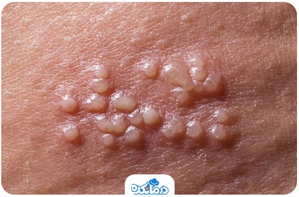  تبخال تناسلی در زنان چگونه به وجود می آید؟