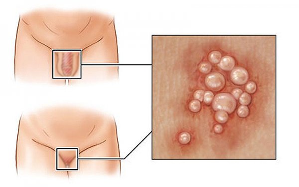  تبخال تناسلی در زنان چگونه به وجود می آید؟