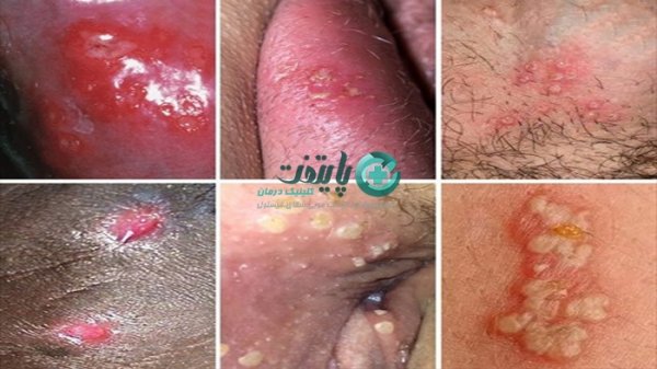  تبخال تناسلی در زنان چگونه به وجود می آید؟