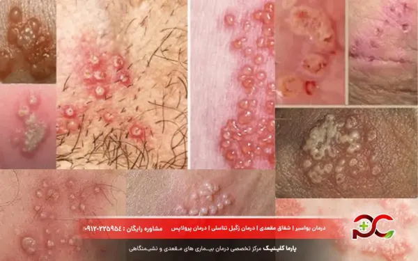  تبخال تناسلی در زنان چگونه به وجود می آید؟