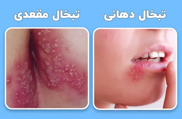  آیا تبخال مقعدی خطرناک است؟