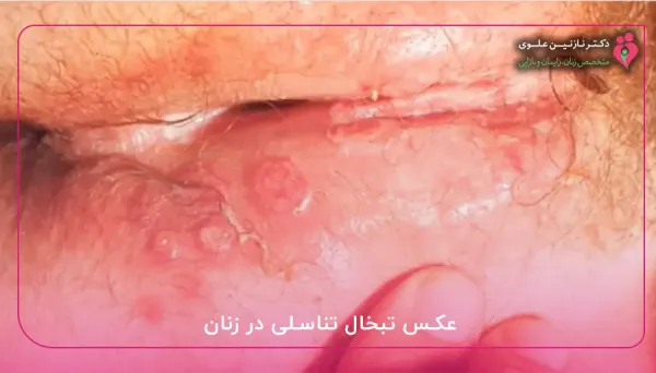  آیا تبخال مقعدی خطرناک است؟