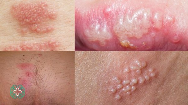  آیا تبخال مقعدی خطرناک است؟