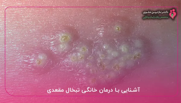 درمان خانگی تبخال مقعدی