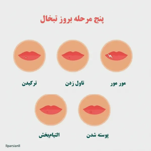  چه کسانی بیشتر تبخال می زنند؟