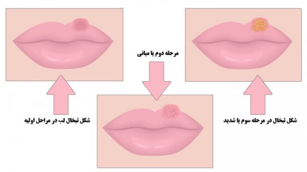  چه کسانی بیشتر تبخال می زنند؟