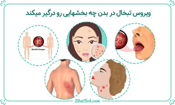  چه کسانی بیشتر تبخال می زنند؟