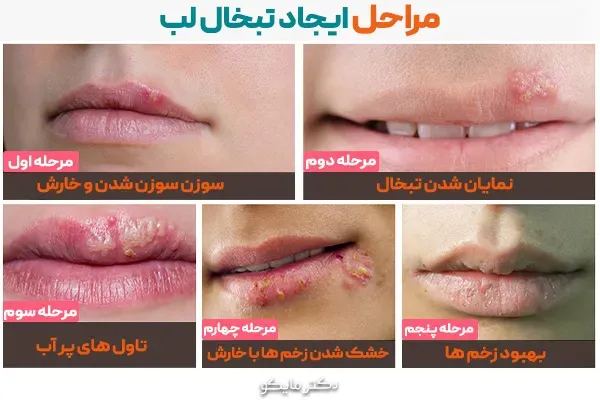  هزینه آزمایش تبخال تناسلی