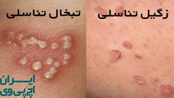  آیا تبخال تناسلی همان HPV است؟