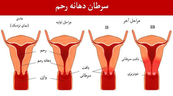  عکس سرطان دهانه رحم