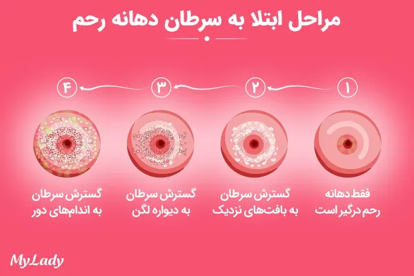  عکس سرطان دهانه رحم