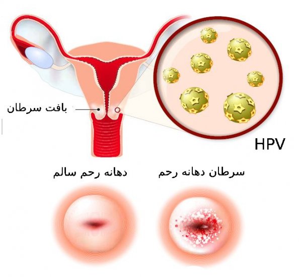  عکس سرطان دهانه رحم