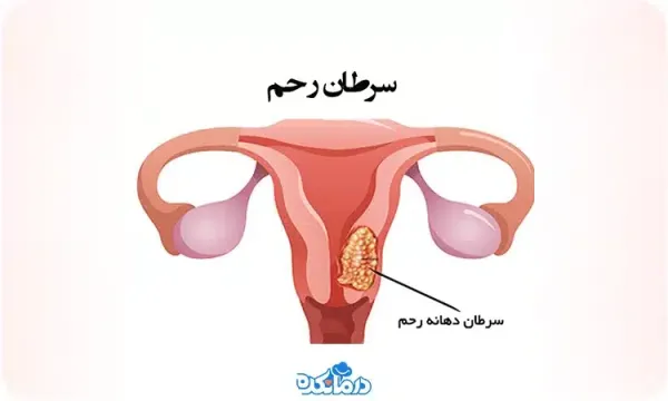 عکس سرطان رحم بدخیم