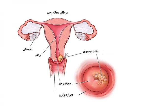  عکس سرطان رحم بدخیم