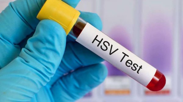 هزینه آزمایش تبخال تناسلی چقدر است؟