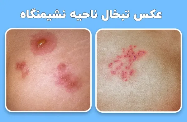 تبخال مقعدی در زنان + عکس واقعی