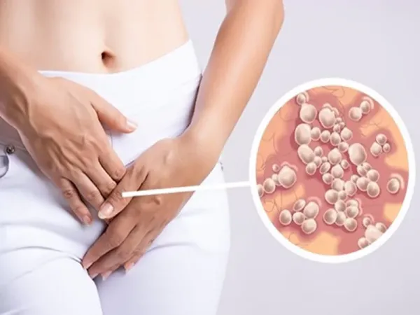 جلوگیری از انتقال تبخال تناسلی