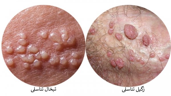  تبخال مقعدی در کودکان + علت و علائم و درمان + عکس