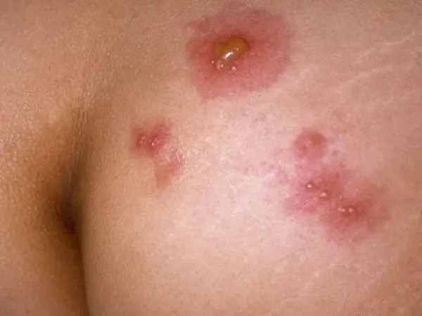  تبخال مقعدی در کودکان + علت و علائم و درمان + عکس