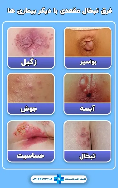  داروی تبخال مقعدی چیست؟