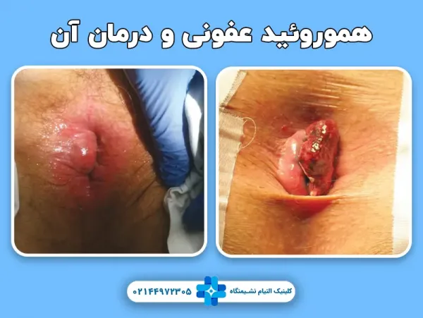 برای عفونت هموروئید چه کنیم + عکس عفونت هموروئید