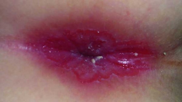 برای درمان زخم هموروئید چه باید کرد؟