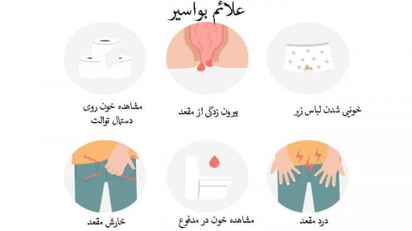  برای درمان زخم هموروئید چه باید کرد؟