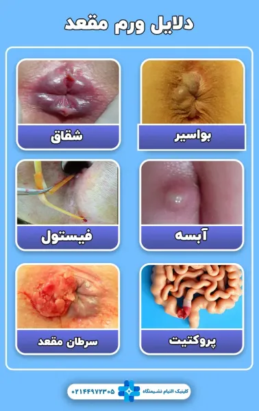  برای درمان زخم هموروئید چه باید کرد؟