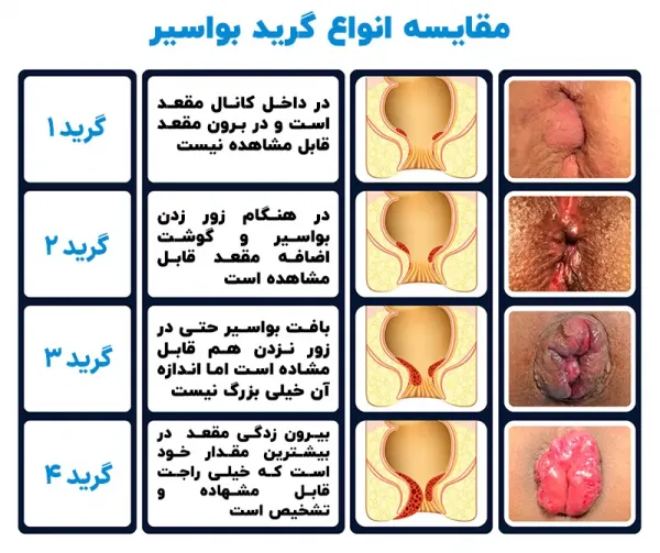  برای درمان زخم هموروئید چه باید کرد؟