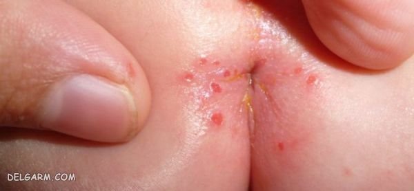 عکس جوش مقعدی نوزاد+ علائم و علت + درمان