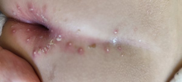  عکس جوش مقعدی نوزاد+ علائم و علت + درمان