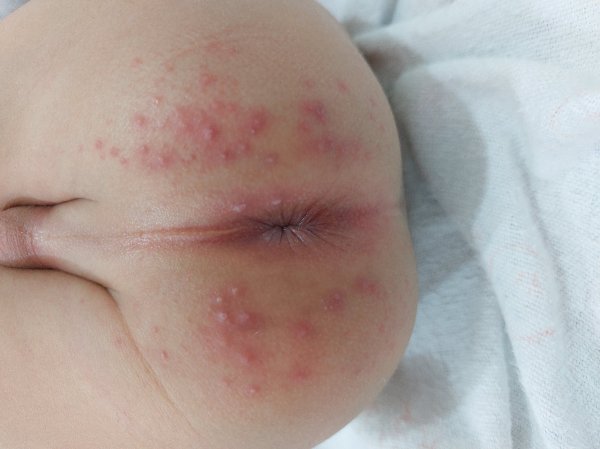  عکس جوش مقعدی نوزاد+ علائم و علت + درمان