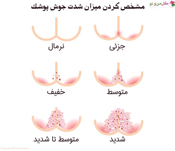  عکس جوش مقعدی نوزاد+ علائم و علت + درمان