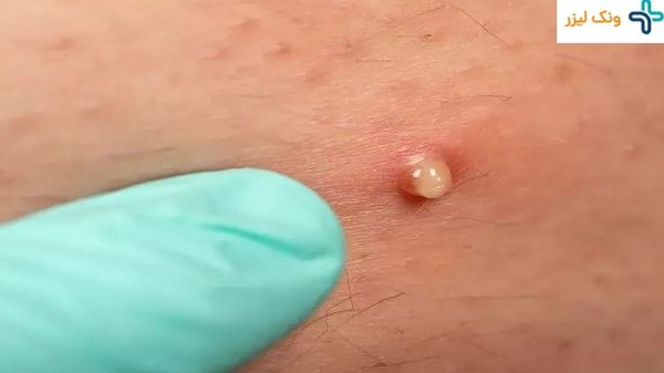  عکس جوش مقعدی نوزاد+ علائم و علت + درمان