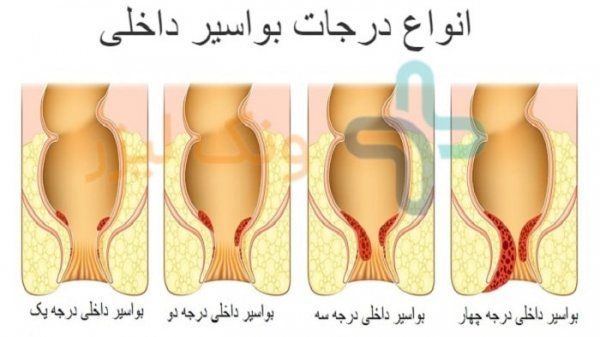  چه پمادی برای جوش مقعدی خوبه؟